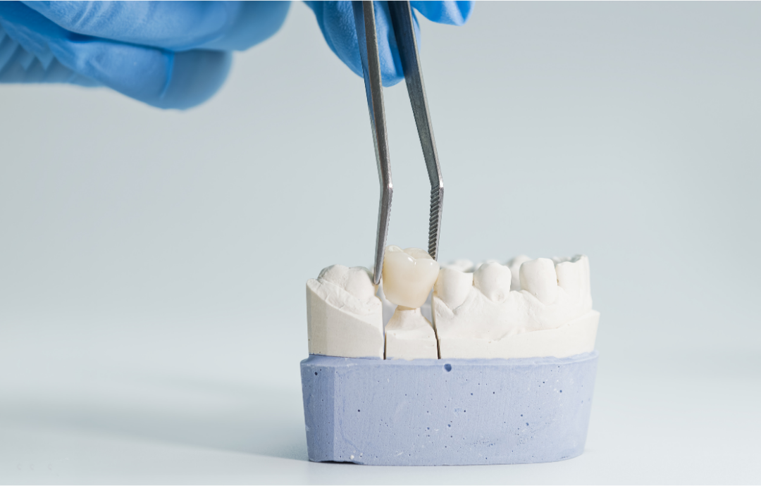 Поставяне на циркониева коронка върху зъбен модел в Smile Care