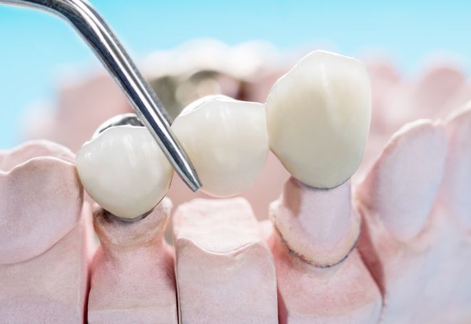 Поставяне на зъбен мост върху зъбен модел в Smile Care