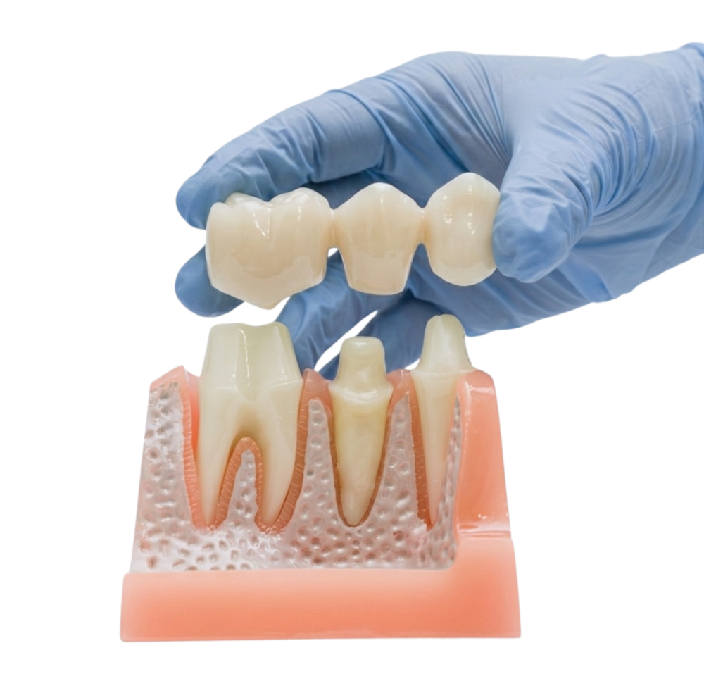 Поставяне на зъбен мост в Smile Care