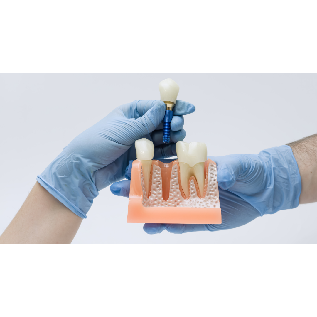 Модел на зъбен имплант — поставяне и възстановяване в Smile Care