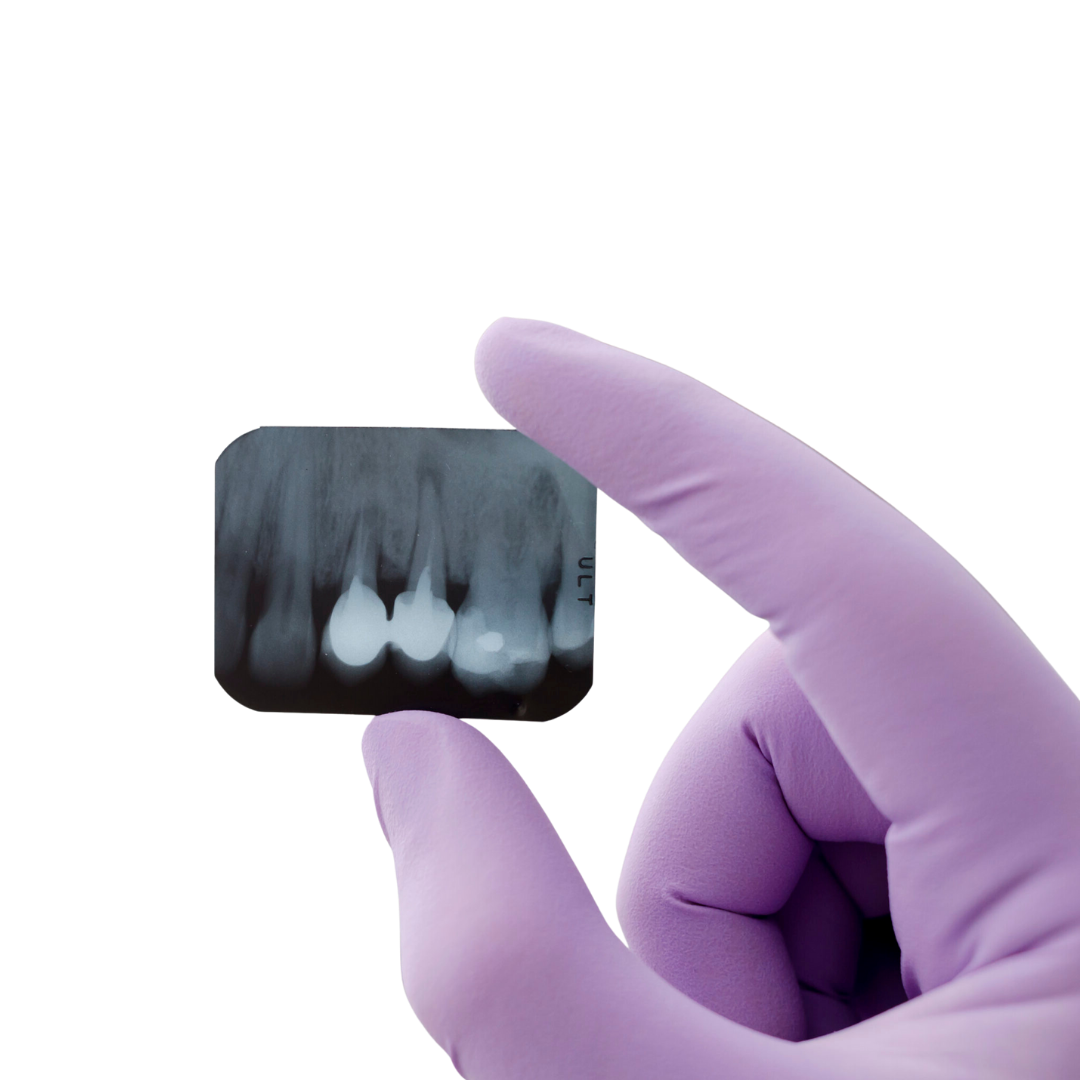 Зъбни снимки — секторна рентгенова диагностика в Smile Care