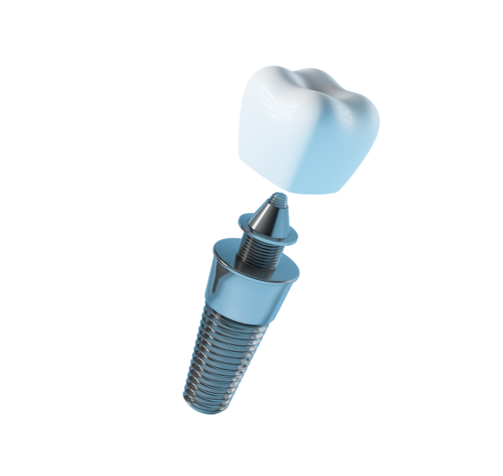 Зъбни импланти — възстановяване на липсващ зъб в Smile Care